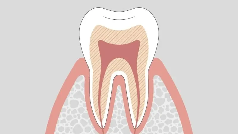 要観察歯 (CO) - Teeth needing observation