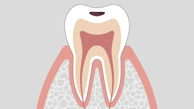 C1 enamel cavity