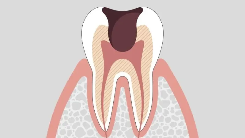 C3: Cavity reaching the pulp