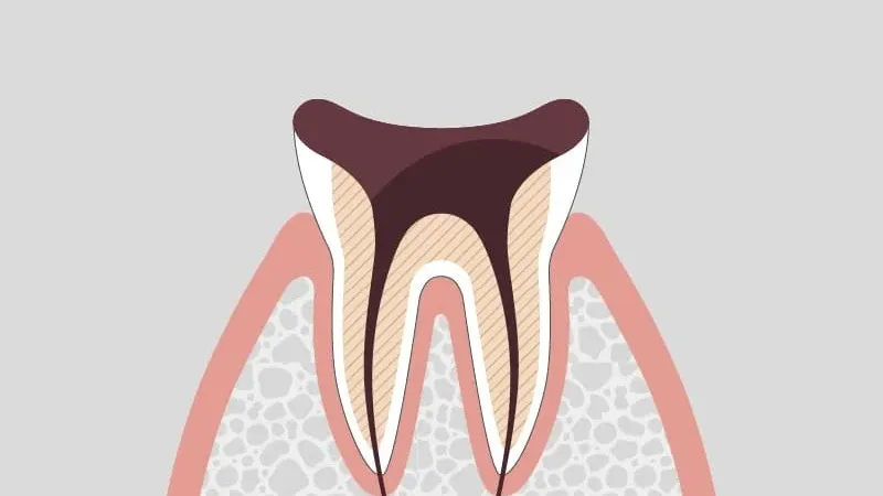 C4 decayed tooth crown