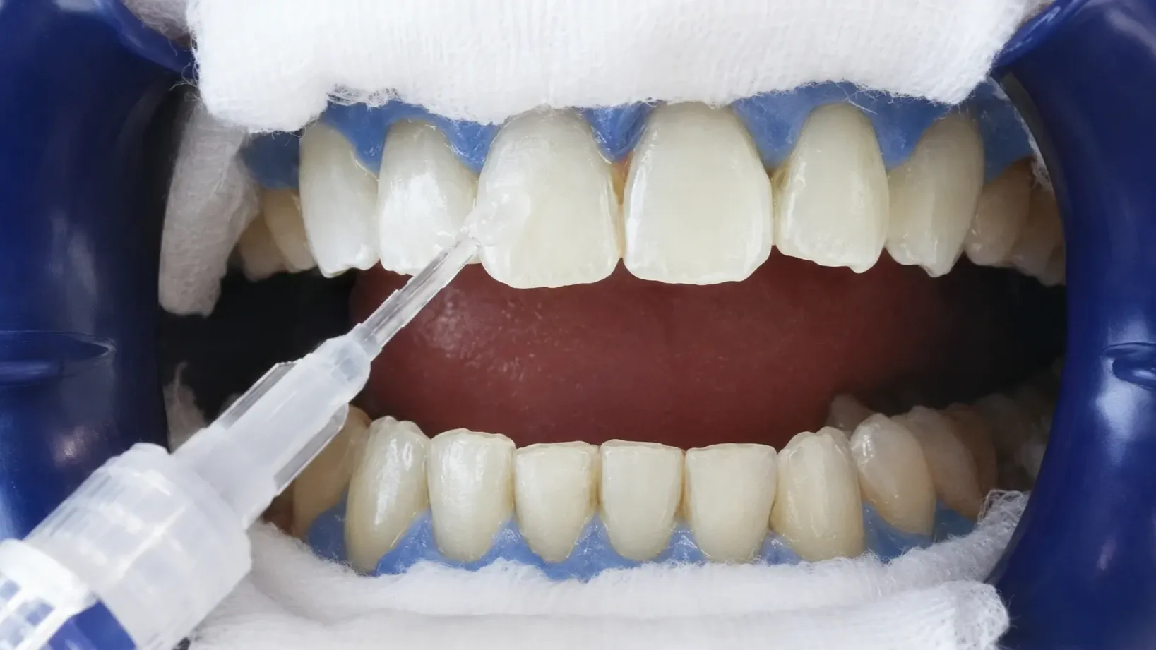 Short time whitening with Tion